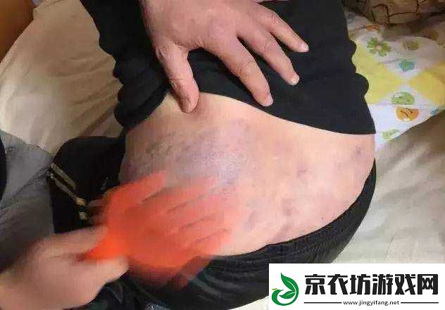 竹板打肿臂缝合不上的意外状况